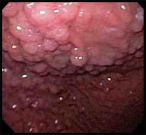 anti-reflux-18