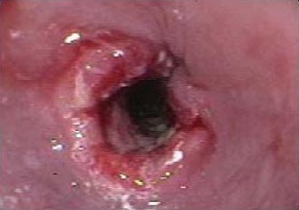 anti-reflux-8