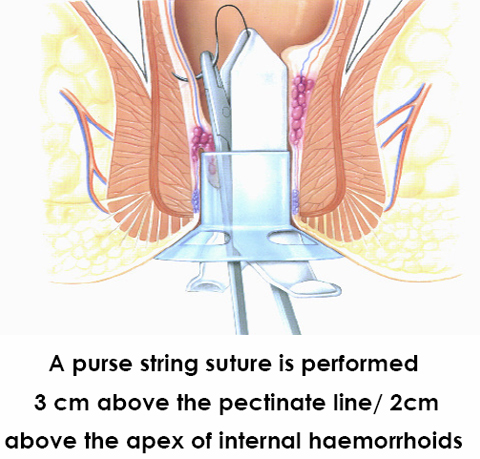 hemorrhoids-22