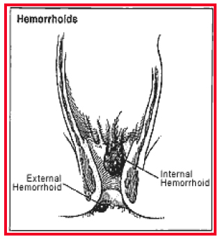 hemorrhoids-3