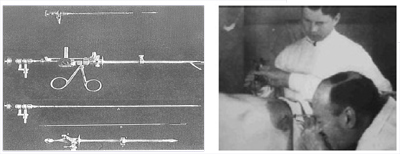 single-incision-1
