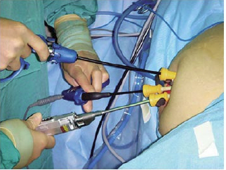 single-incision-8