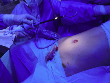 single-incision-9
